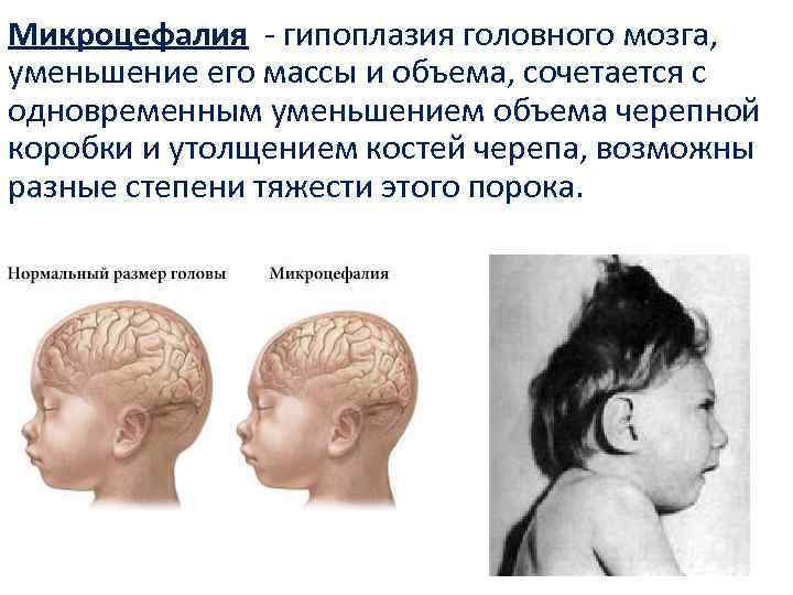 Микроцефалия - гипоплазия головного мозга, уменьшение его массы и объема, сочетается с одновременным уменьшением