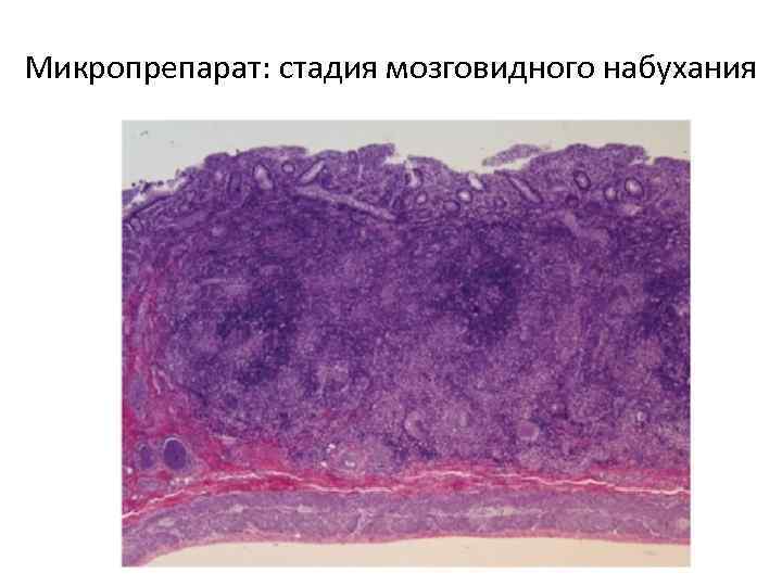 Микропрепарат: стадия мозговидного набухания 