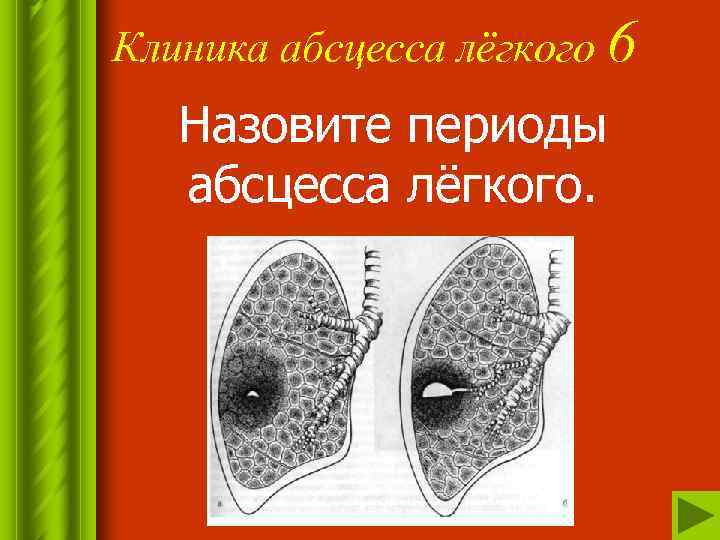 Клиника абсцесса лёгкого 6 Назовите периоды абсцесса лёгкого. 