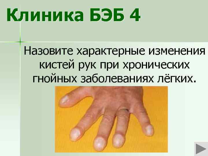 Клиника БЭБ 4 Назовите характерные изменения кистей рук при хронических гнойных заболеваниях лёгких. 
