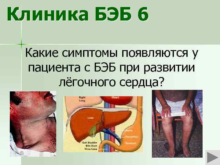 Клиника БЭБ 6 Какие симптомы появляются у пациента с БЭБ при развитии лёгочного сердца?