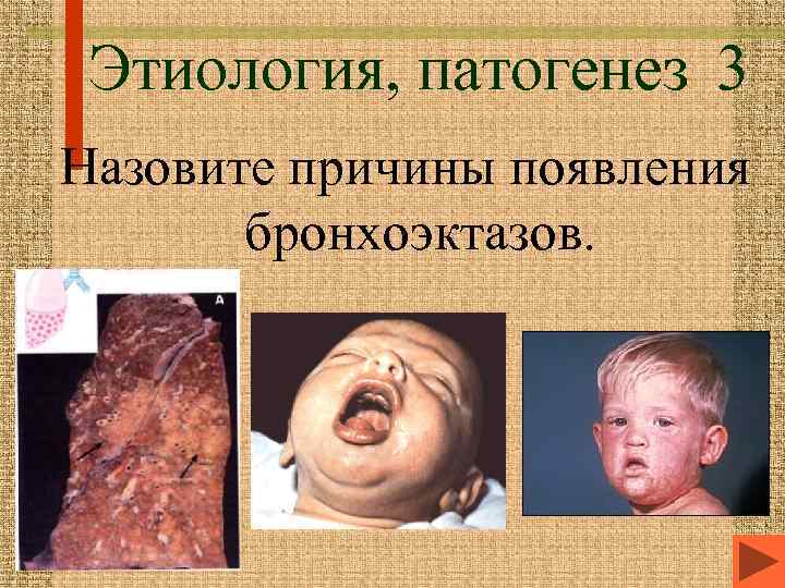 Этиология, патогенез 3 Назовите причины появления бронхоэктазов. 