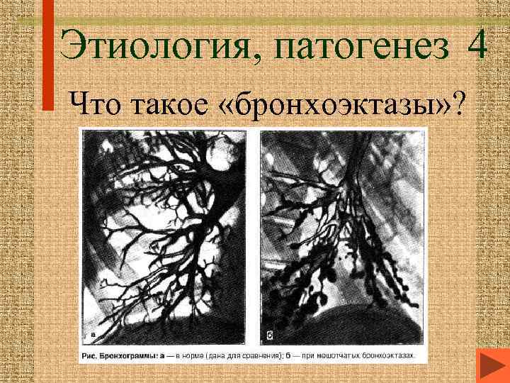 Этиология, патогенез 4 Что такое «бронхоэктазы» ? 