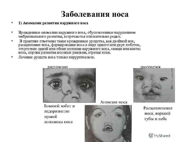 Заболевания носа • 1) Аномалии развития наружного носа • Врожденные аномалии наружного носа, обусловленные