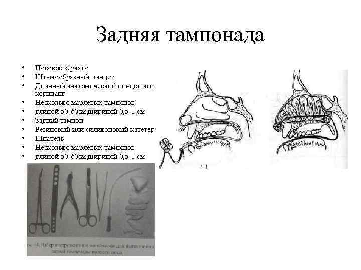 Задняя тампонада • • • Носовое зеркало Штыкообразный пинцет Длинный анатомический пинцет или корнцанг