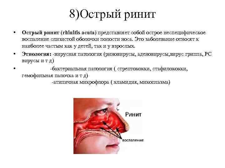 8)Острый ринит • • • Острый ринит (rhinitis acuta) представляет собой острое неспецифическое воспаление