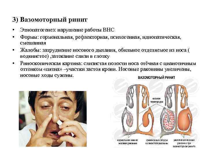 3) Вазомоторный ринит • • Этиопатогенез: нарушение работы ВНС Формы: гормональная, рефлекторная, психогенная, идиопатическая,