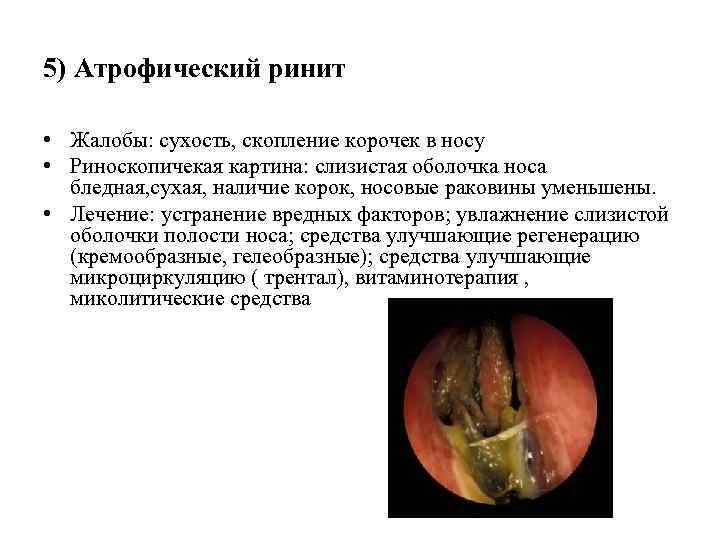 5) Атрофический ринит • Жалобы: сухость, скопление корочек в носу • Риноскопичекая картина: слизистая