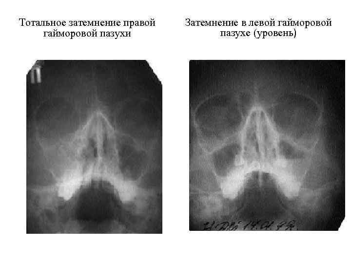 Тотальное затемнение правой гайморовой пазухи Затемнение в левой гайморовой пазухе (уровень) 
