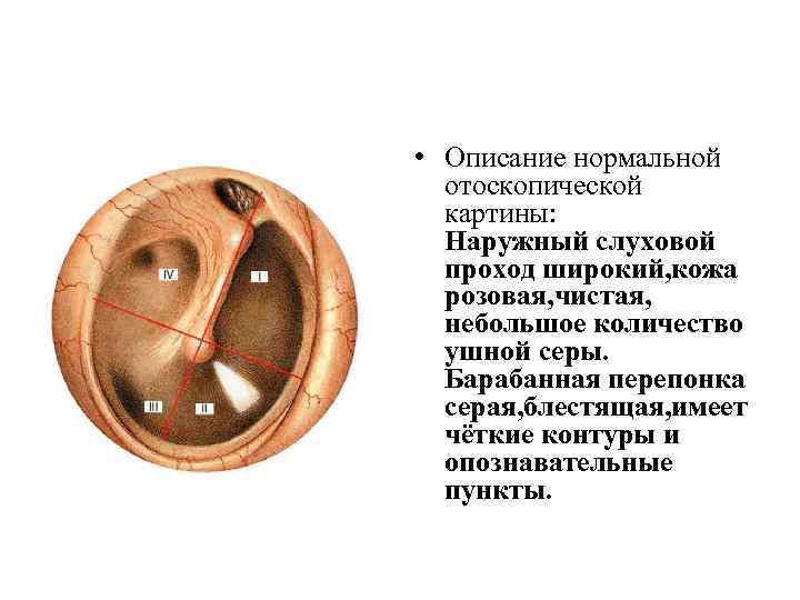  • Описание нормальной отоскопической картины: Наружный слуховой проход широкий, кожа розовая, чистая, небольшое