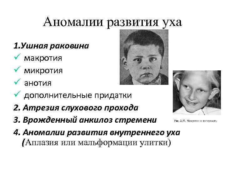 Аномалии развития уха 1. Ушная раковина макротия микротия анотия дополнительные придатки 2. Атрезия слухового