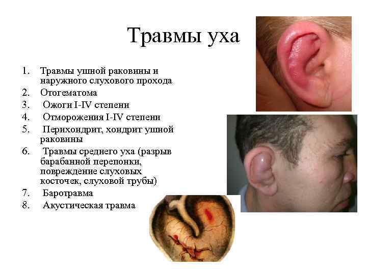 Травмы уха 1. 2. 3. 4. 5. 6. 7. 8. Травмы ушной раковины и