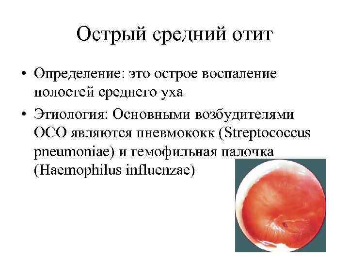 Острый средний отит • Определение: это острое воспаление полостей среднего уха • Этиология: Основными