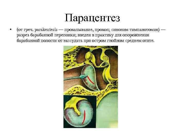 Парацентез • (от греч. parakentesis — прокалывание, прокол; синоним тимпанотомия) — разрез барабанной перепонки;