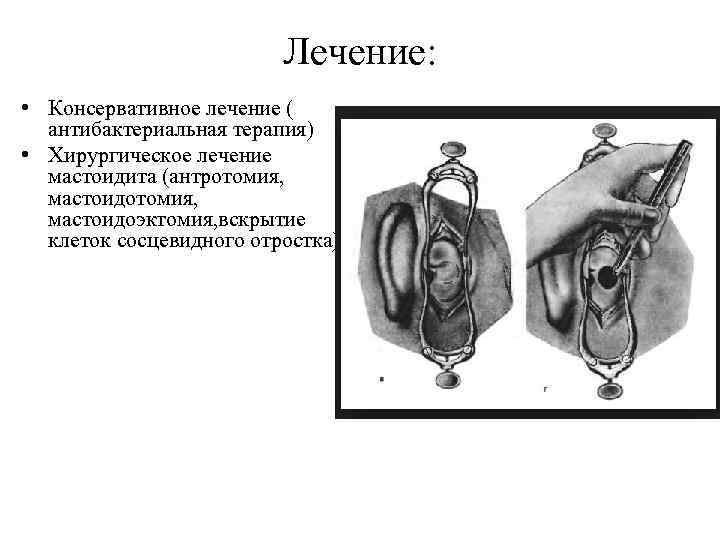 Лечение: • Консервативное лечение ( антибактериальная терапия) • Хирургическое лечение мастоидита (антротомия, мастоидоэктомия, вскрытие