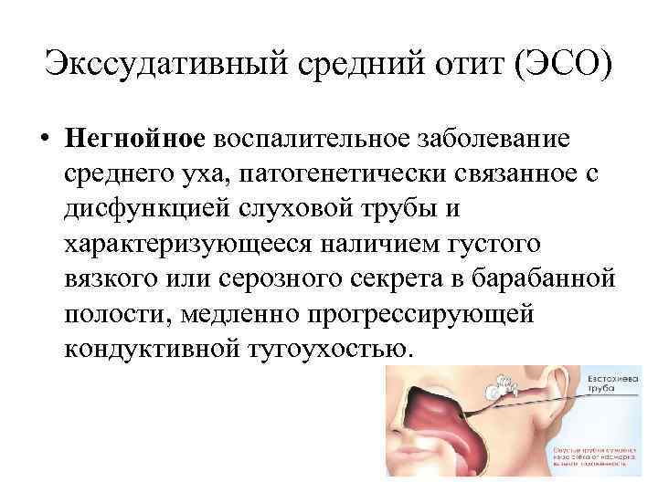 Экссудативный средний отит (ЭСО) • Негнойное воспалительное заболевание среднего уха, патогенетически связанное с дисфункцией