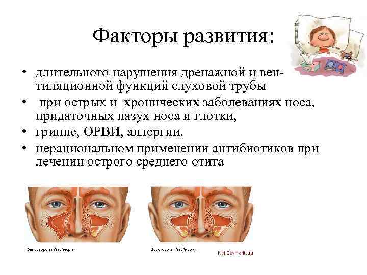Факторы развития: • длительного нарушения дренажной и вен- тиляционной функций слуховой трубы • при