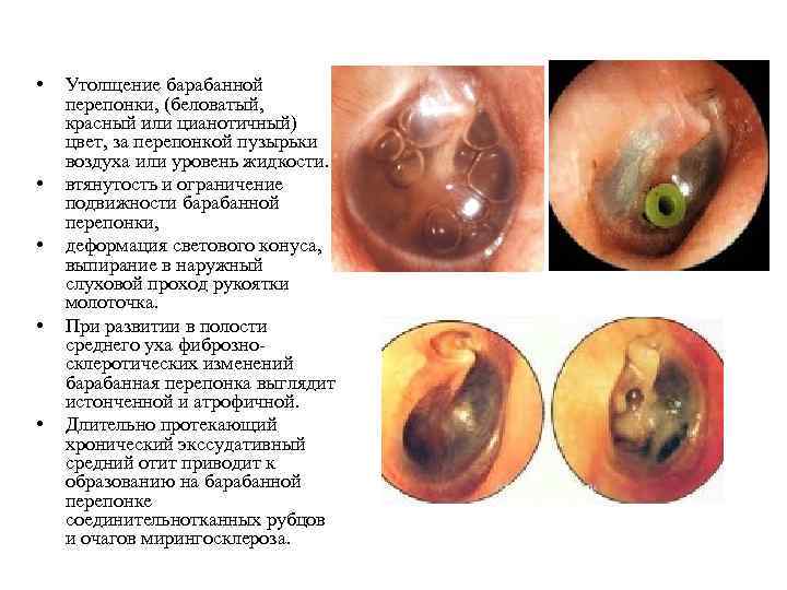  • • • Утолщение барабанной перепонки, (беловатый, красный или цианотичный) цвет, за перепонкой