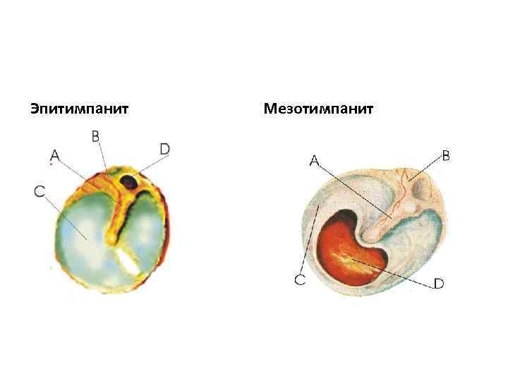 Эпитимпанит Мезотимпанит 