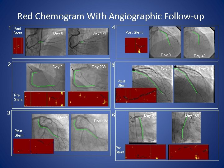 Red Chemogram With Angiographic Follow-up 1 Post Stent 4 Day 0 Post Stent Day