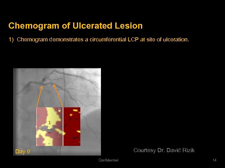 Chemogram of Ulcerated Lesion 1) Chemogram demonstrates a circumferential LCP at site of ulceration.