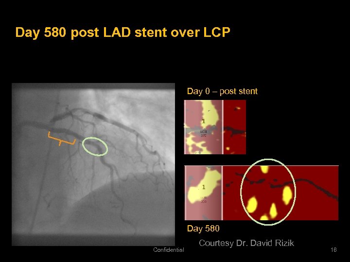 Day 580 post LAD stent over LCP Day 0 – post stent Day 580