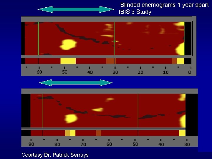 Blinded chemograms 1 year apart IBIS 3 Study Courtesy Dr. Patrick Serruys 