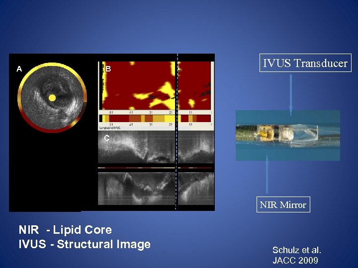 A B IVUS Transducer C D pre E Post-stenting NIR Mirror NIR - Lipid