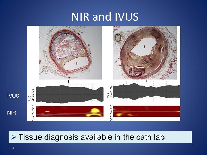NIR and IVUS NIR Ø Tissue diagnosis available in the cath lab 4 