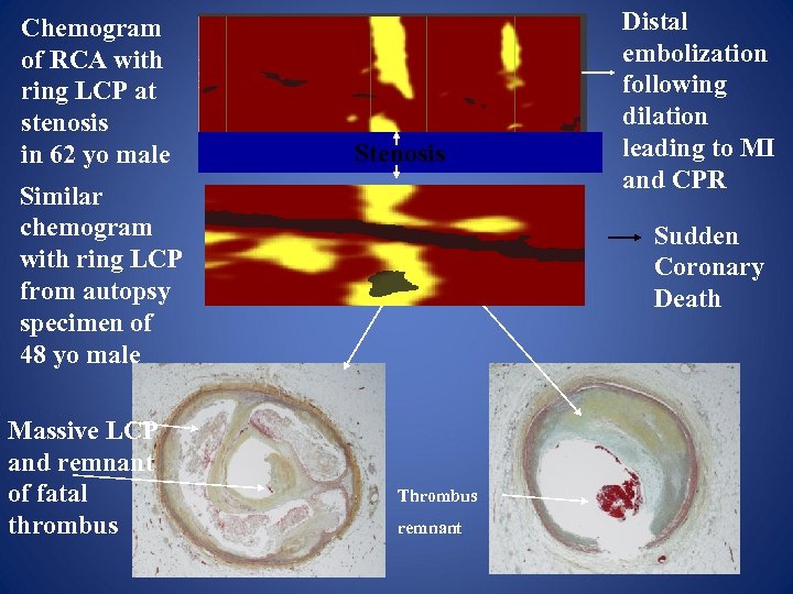 Chemogram of RCA with ring LCP at stenosis in 62 yo male Stenosis Similar