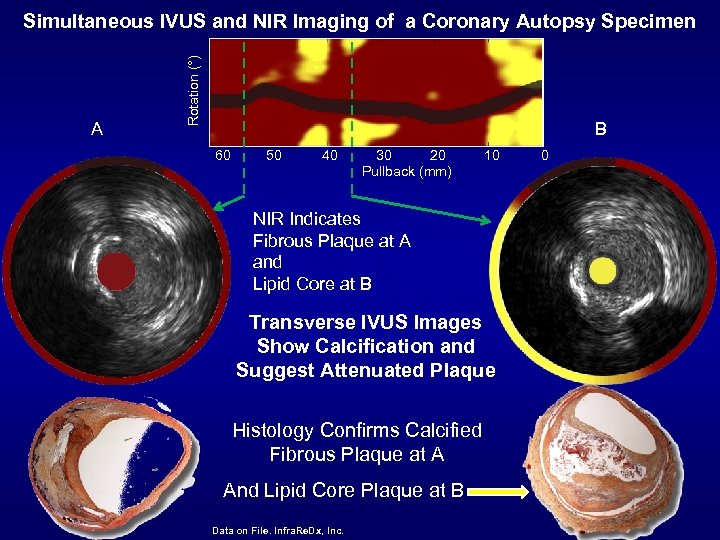 A Rotation (°) Simultaneous IVUS and NIR Imaging of a Coronary Autopsy Specimen B