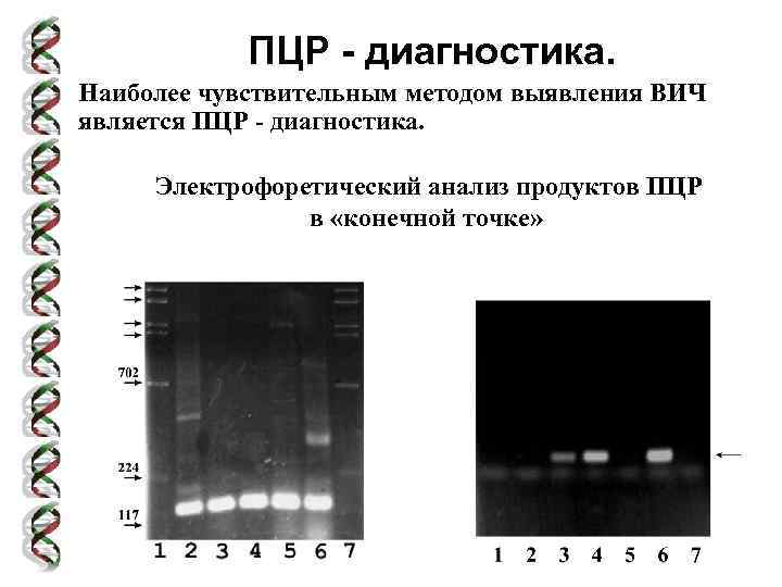 ПЦР - диагностика. Наиболее чувствительным методом выявления ВИЧ является ПЦР - диагностика. Электрофоретический анализ