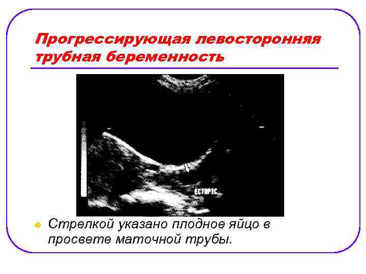 Прогрессирующая левосторонняя трубная беременность l Стрелкой указано плодное яйцо в просвете маточной трубы. 