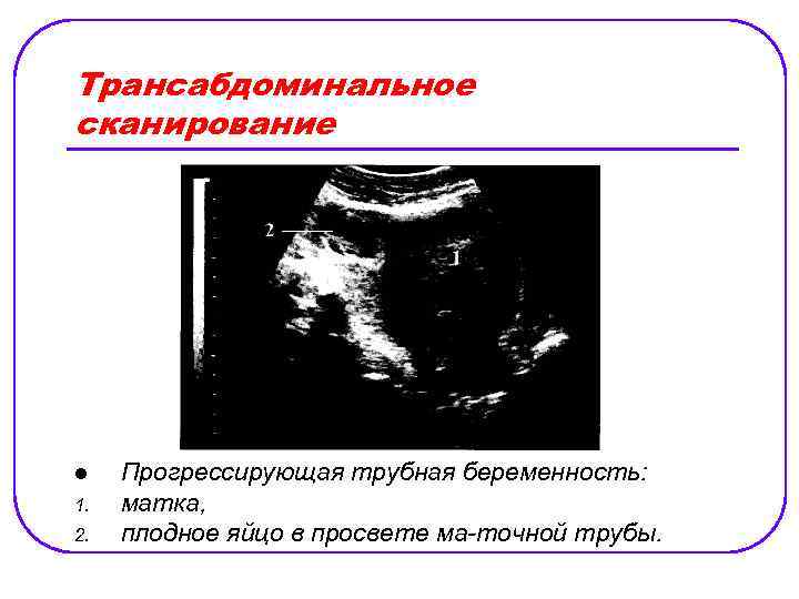 Трансабдоминальное сканирование l 1. 2. Прогрессирующая трубная беременность: матка, плодное яйцо в просвете ма