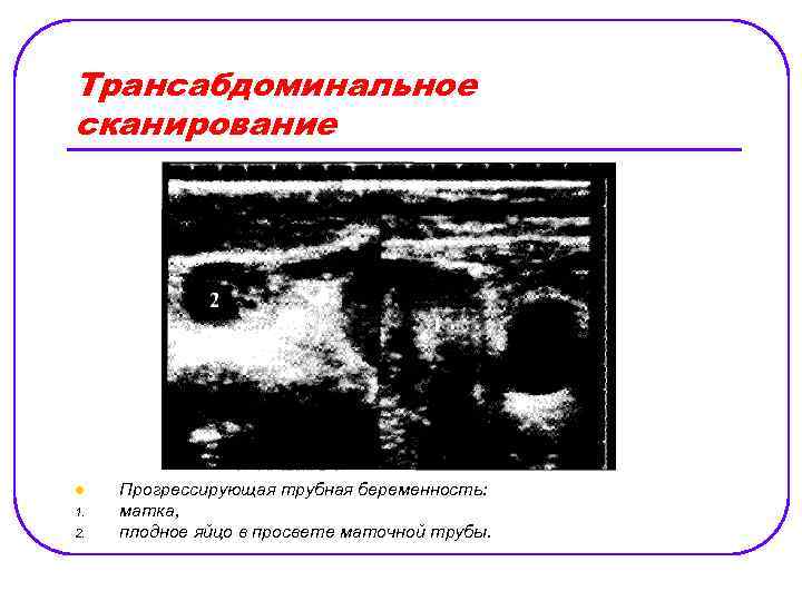 Трансабдоминальное сканирование l 1. 2. Прогрессирующая трубная беременность: матка, плодное яйцо в просвете маточной