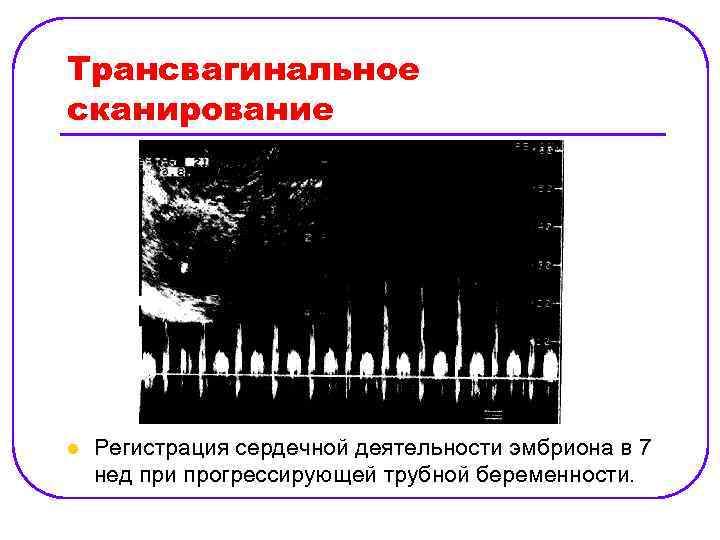 Трансвагинальное сканирование l Регистрация сердечной деятельности эмбриона в 7 нед при прогрессирующей трубной беременности.