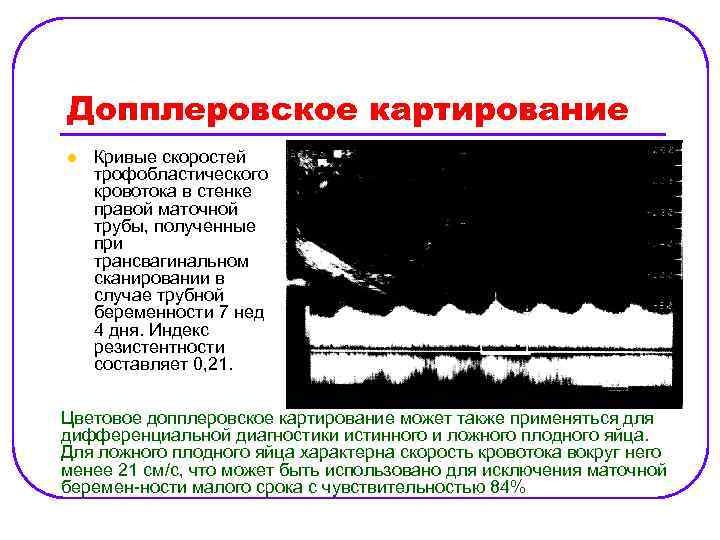 Допплеровское картирование l Кривые скоростей трофобластического кровотока в стенке правой маточной трубы, полученные при