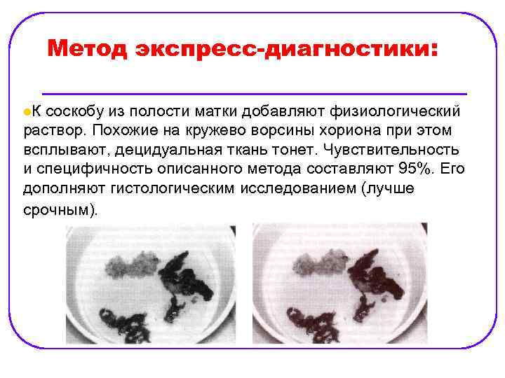 Метод экспресс-диагностики: l. К соскобу из полости матки добавляют физиологический раствор. Похожие на кружево