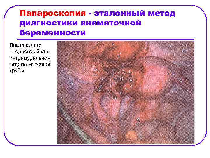 Лапароскопия - эталонный метод диагностики внематочной беременности Локализация плодного яйца в интрамуральном отделе маточной