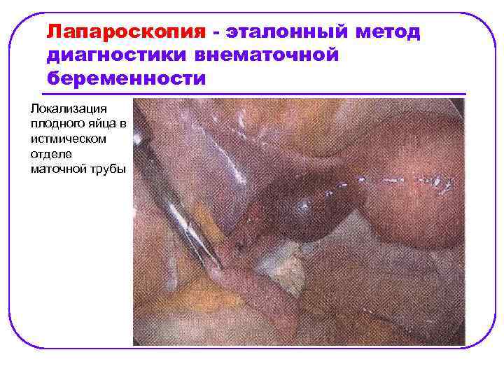 Лапароскопия - эталонный метод диагностики внематочной беременности Локализация плодного яйца в истмическом отделе маточной