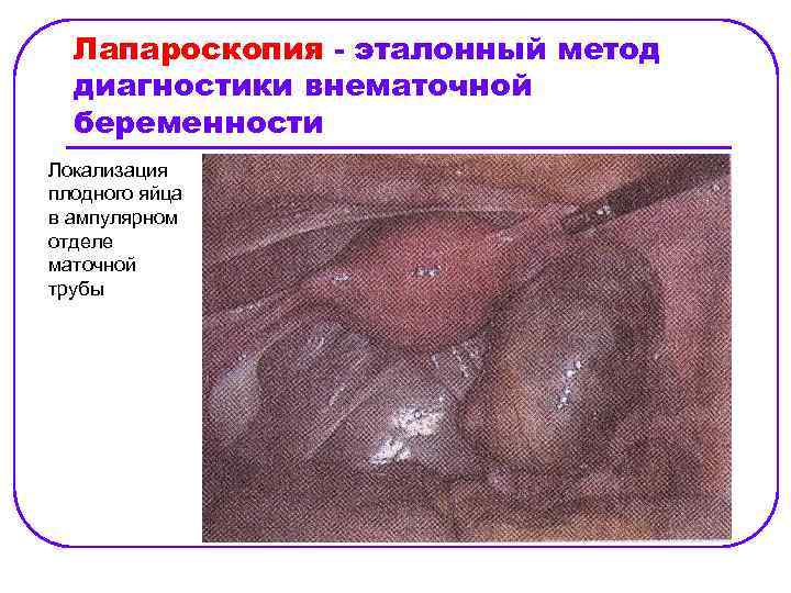 Лапароскопия - эталонный метод диагностики внематочной беременности Локализация плодного яйца в ампулярном отделе маточной