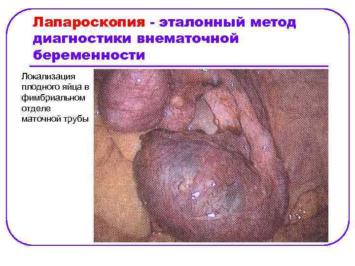 Лапароскопия - эталонный метод диагностики внематочной беременности Локализация плодного яйца в фимбриальном отделе маточной
