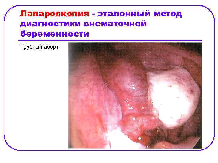 Лапароскопия - эталонный метод диагностики внематочной беременности Трубный аборт 