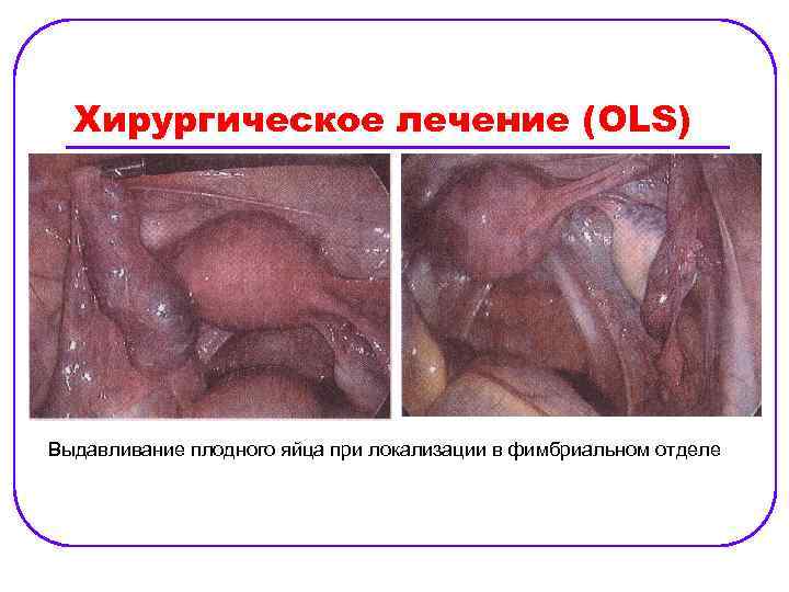 Хирургическое лечение (OLS) Выдавливание плодного яйца при локализации в фимбриальном отделе 