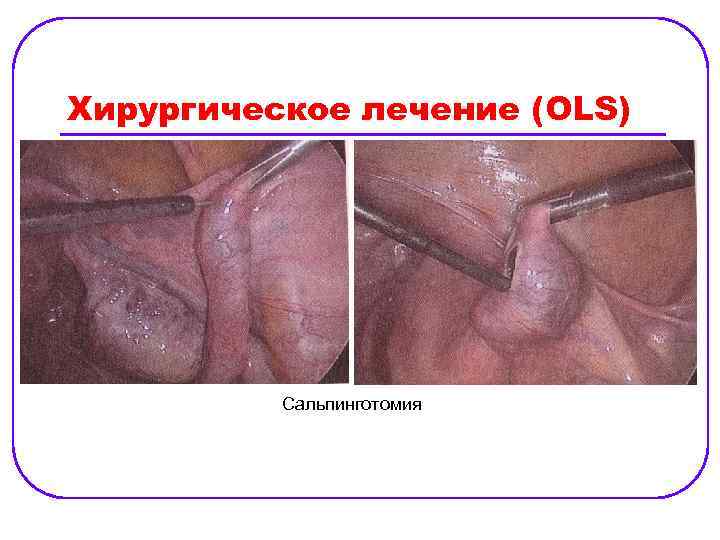 Хирургическое лечение (OLS) Сальпинготомия 