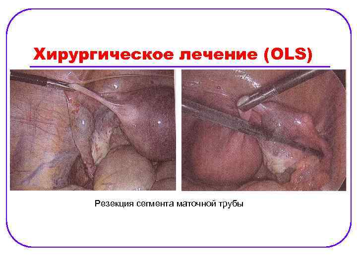 Хирургическое лечение (OLS) Резекция сегмента маточной трубы 