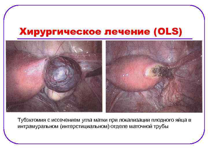 Хирургическое лечение (OLS) Тубэктомия с иссечением угла матки при локализации плодного яйца в интрамуральном
