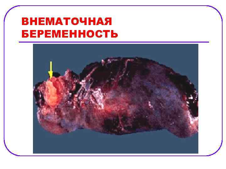 ВНЕМАТОЧНАЯ БЕРЕМЕННОСТЬ 