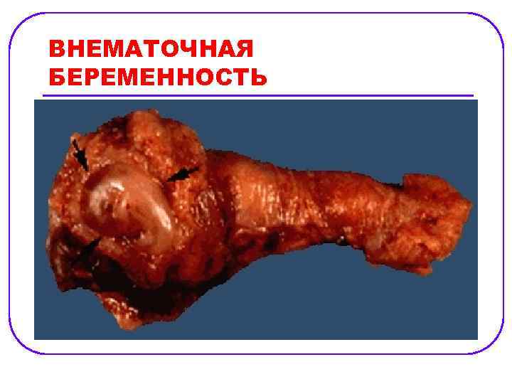 ВНЕМАТОЧНАЯ БЕРЕМЕННОСТЬ 