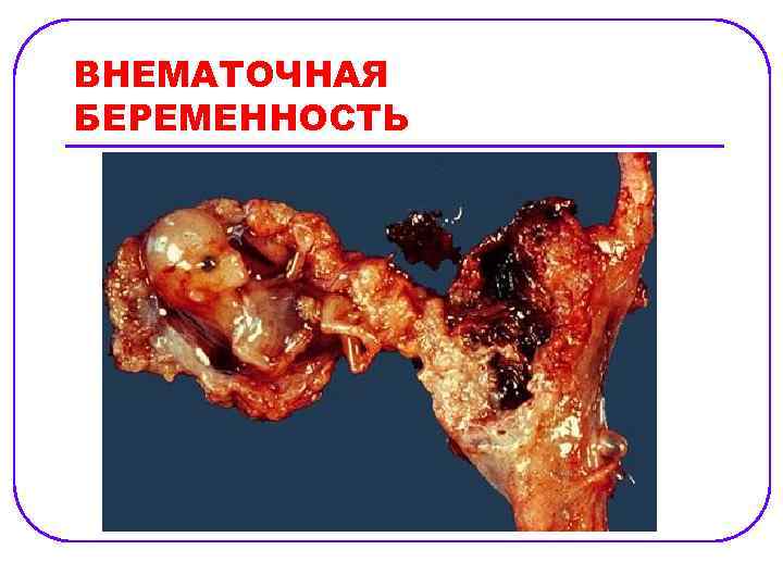 ВНЕМАТОЧНАЯ БЕРЕМЕННОСТЬ 